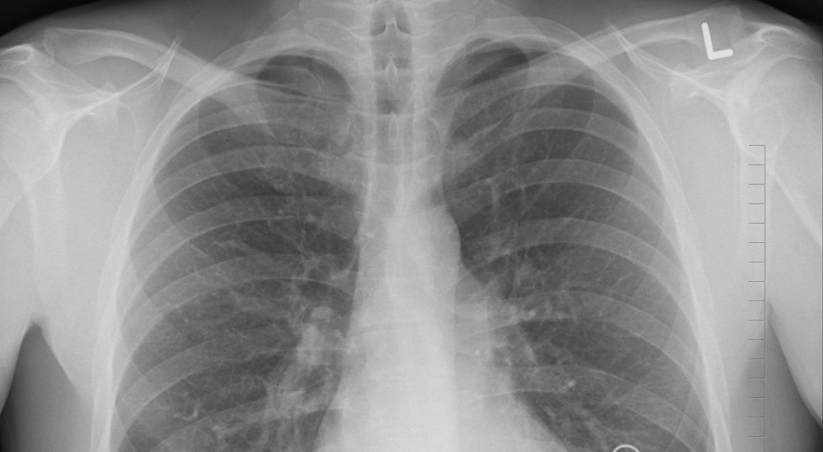 xray