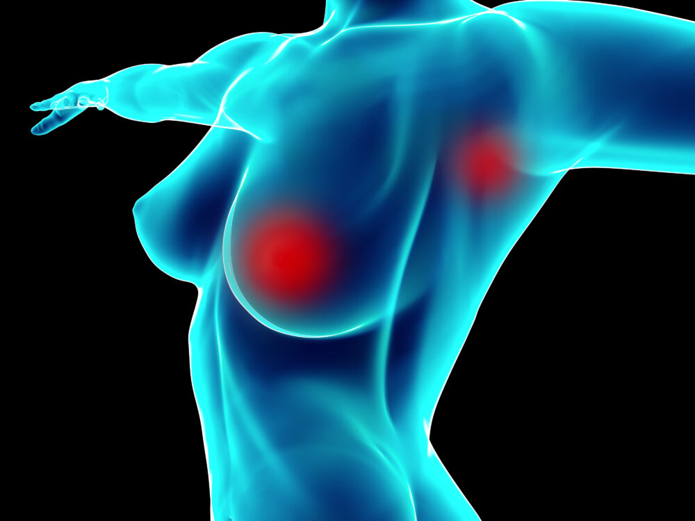 Breast,Cancer